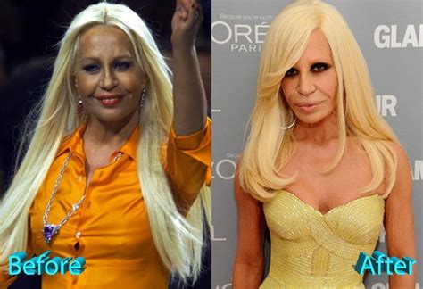 donatella versace interventi chirurgici|CELEBRITY BEFORE AND AFTER PLASTIC SURGERY.